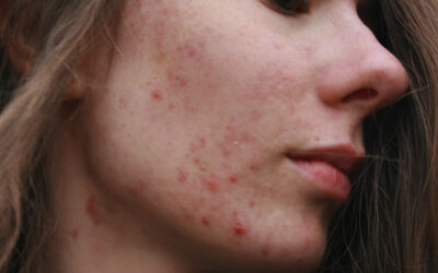 Acne Attiva