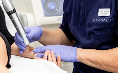 RIMOZIONE TATUAGGI CON IL LASER: APPROCCIO SCIENTIFICO ED EFFICACIA DEL TRATTAMENTO